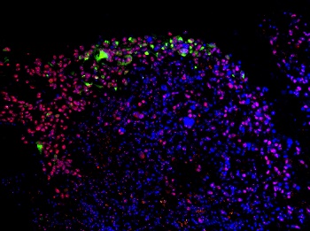 Zika destruiu tumor cerebral e pode ser Ãºtil no combate ao cÃ¢ncer diz estudo